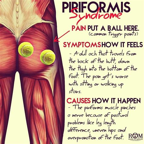 Piriformis syndrome exercises alleviating a pain in the butt – Artofit