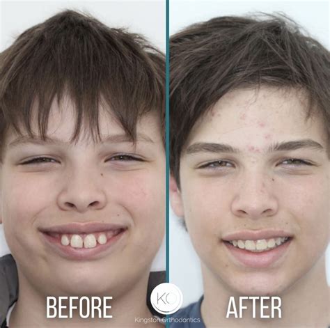 Discover How Braces Effectively Correct Overbites