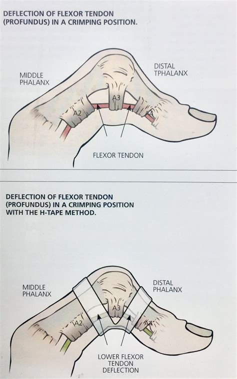 Pulley Taping: Why The H-Tape Method? — Grassroots Physical Therapy