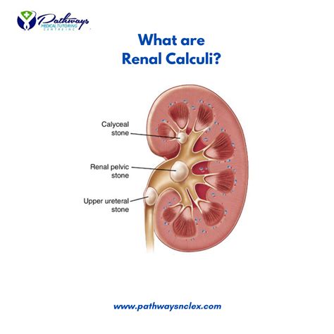 Renal Calculi (Kidney Stones): Essential Guide for NCLEX Exam – Pathways Nclex