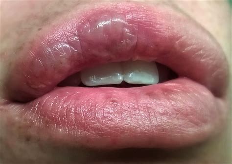 Kuvatulokset haulle blister on inner lip of mouth