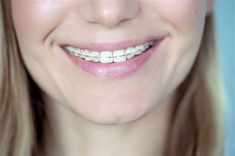 I Got Braces at 60 Years Old, and My Smile’s Never Looked Better HD Wallpaper