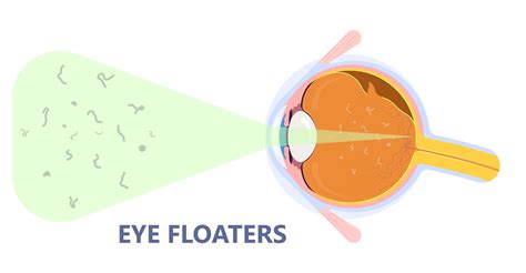 Eye Floater Flashes