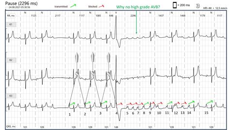 Why is this not second degree AVB Type II and no high grade AVB | ECG ...