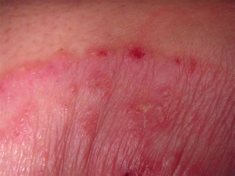 Dermatitis Intimbereich : Vulva-Dermatitis: Symptome und Behandlung – WACX