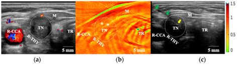 Photoacoustic Tomography Combined with Ultrasound Mapping for Guiding ...