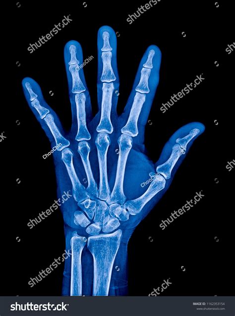 Normal Hand X Ray
