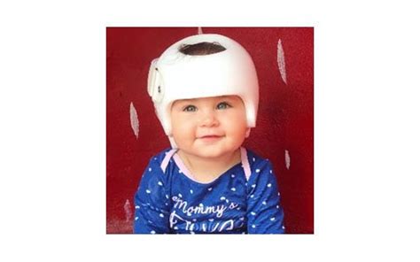 No #1 Cranial Remolding Helmet for Newborns in India | KARE