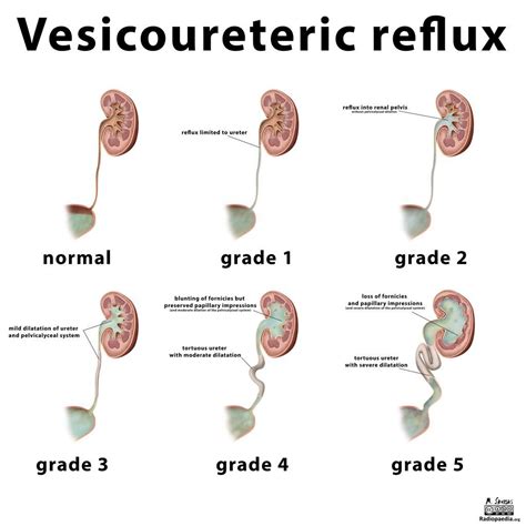 Illustration - vesicoureteric reflux grading | Radiology Case | Radiopaedia.org | Reflux, Renal ...