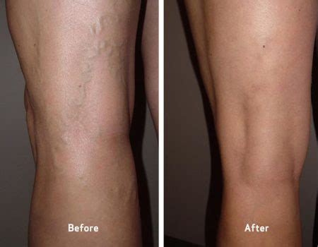 Our Results — Varicose Veins Before & After | Flowcare Jaipur