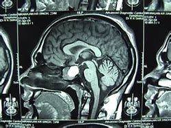 Dr. Partha Pratim Bishnu - India / Kolkata, Pituitary Tumor Surgery ...