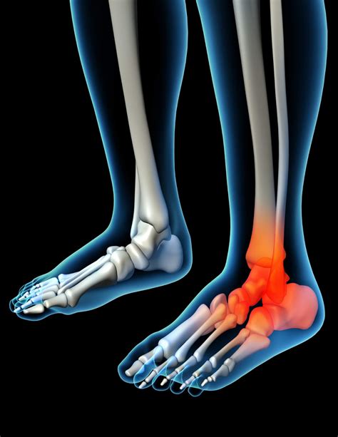 Foot Pain & Plantar Fasciitis: Causes & Treatment - FSAP Care