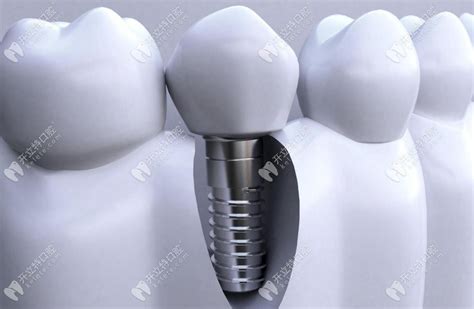 齿度资讯-厦门牙齿矫正,厦门正畸,厦门牙齿种植,厦门种植牙,厦门齿度口腔