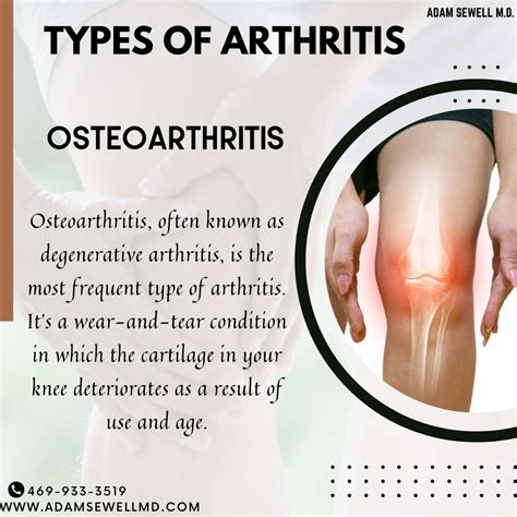 What does arthritis pain feel like – Artofit