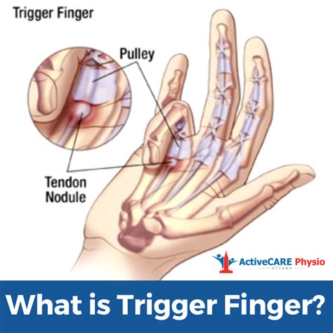 Trigger Finger Trigger Finger Surgery Dr Mark Gittos Plastic Surgeon