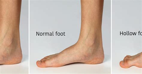 Flat Feet | Treatments, Symptoms, and Causes | CLS Health