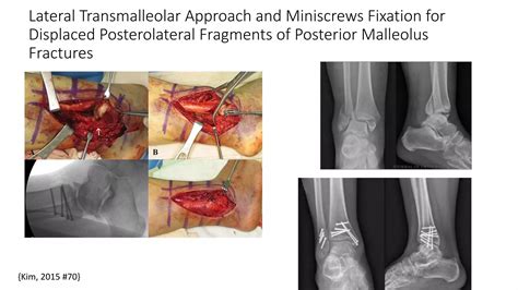 Ankle fracture: posterior malleolar fractures | PPTX