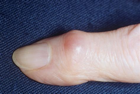 Pointer Finger Knuckle Joint Pain at Janet Grimm blog