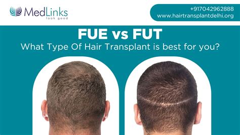 FUT Hair Transplant | Holborn Hair Scalp Clinic | London
