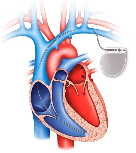Pacemaker Procedure 的图像结果