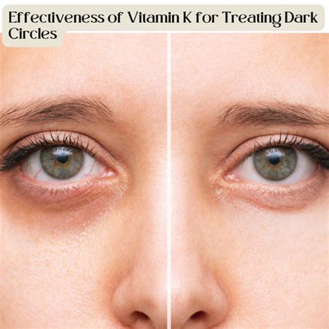 Exploring Vitamin K: Can It Really Help with Dark Circles? | Clinikally