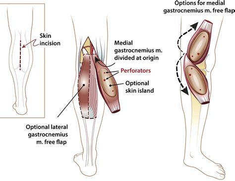 The Gastrocnemius Flap for Lower Extremity Reconstruction - Clinics in Podiatric Medicine and ...