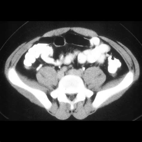 Pediatric Appendicitis | Pediatric Radiology Reference Article | Pediatric Imaging | @pedsimaging