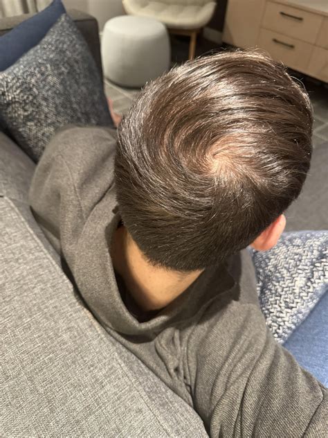 What Is The Best Haircut For Balding Crown - BEST MEN HAIRCUTS 2025