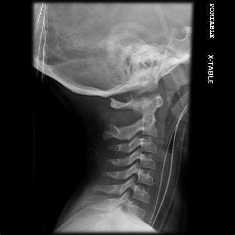 Normal Cervical Spine Radiographs Image Radiopaediaorg