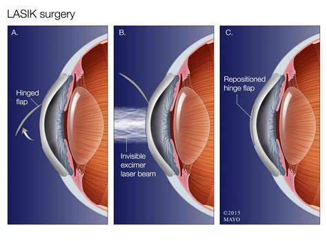 Lasik Eye Surgery, which is the short form for "Laser-Assisted In Situ Keratomileusis", is ...