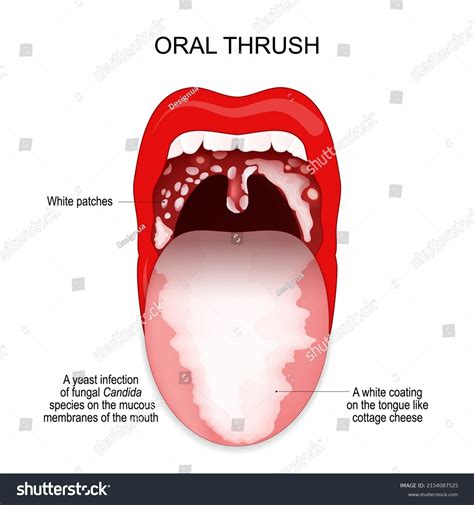 구강 입 점막에 곰팡이 칸디다 종의 스톡 벡터(로열티 프리) 2154087525 | Shutterstock