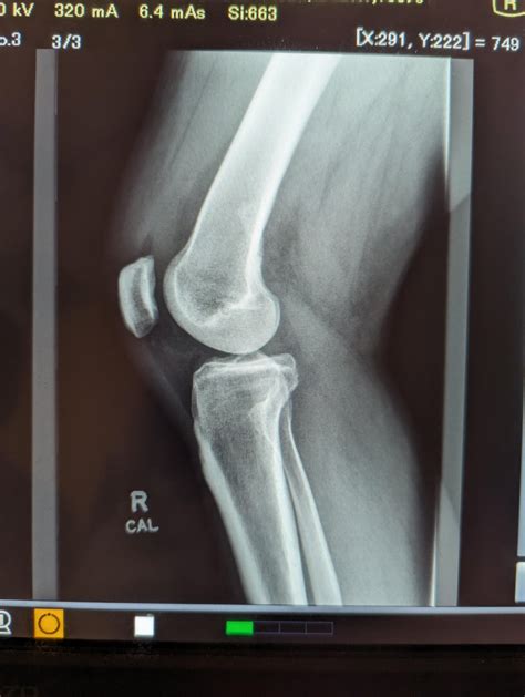 My 1st try Lateral Knee : r/Radiology