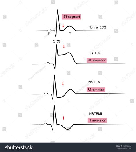 Non Stemi Vs Nstemi