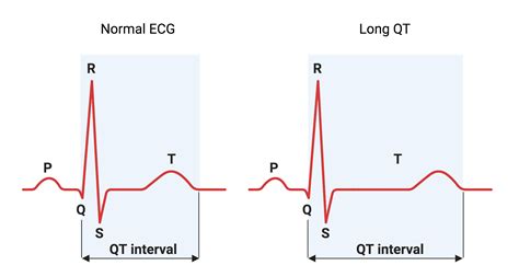 Long QT | BioRender Science Templates