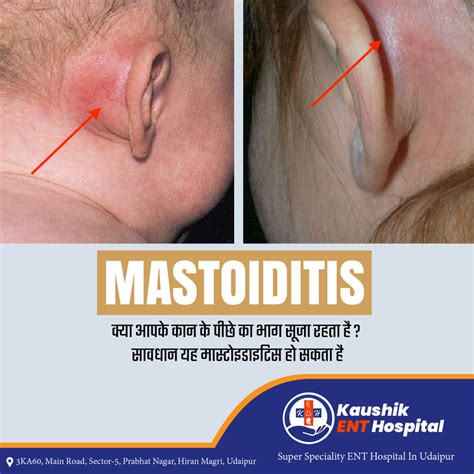 Mastoiditis Treatment in Udaipur | Kaushik ENT Hospital