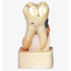 Dissected Model of Dental Disease – HomoSapiens