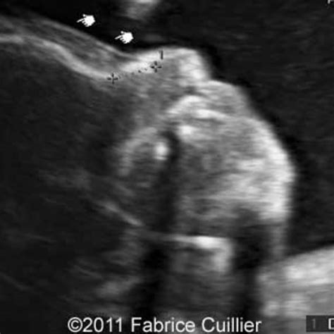 Pyelectasis Of Fetus