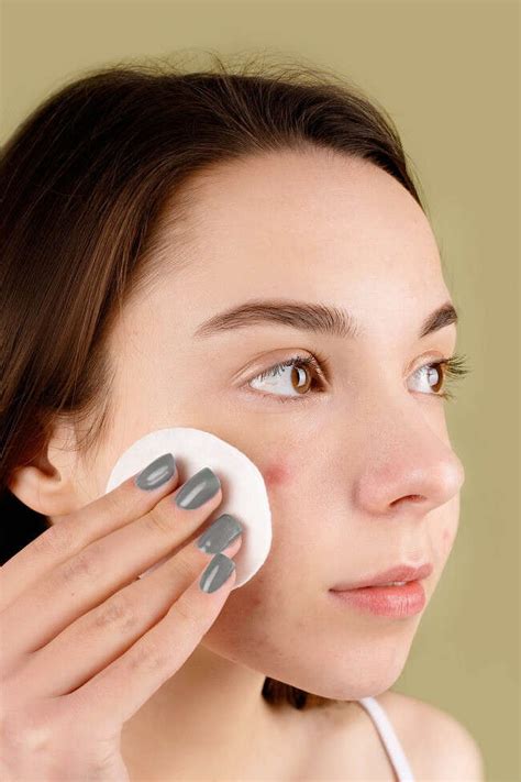 Acne-Prone Skin Deserves TLC Too: The Importance of Moisturizing ...