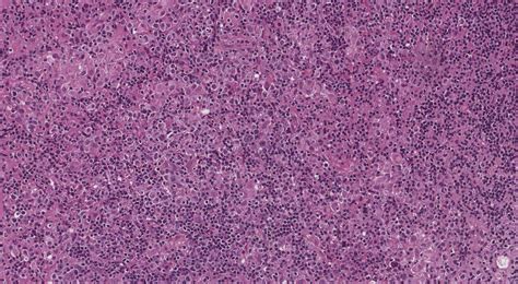 Your pathology report for EBV-positive diffuse large B cell lymphoma | MyPathologyReport