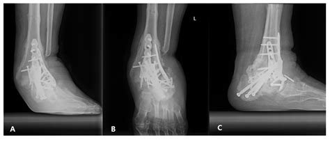 Iatrogenic Ankle Charcot Neuropathic Arthropathy after Spinal Surgery: A Case Report and ...