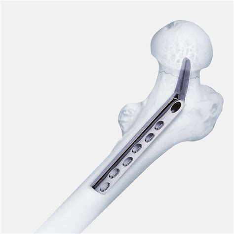 Standard Trauma | SiS medical Co., Ltd.