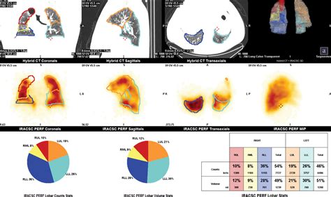 What Is A Lung Ventilation/Perfusion Scan at Stan Denham blog