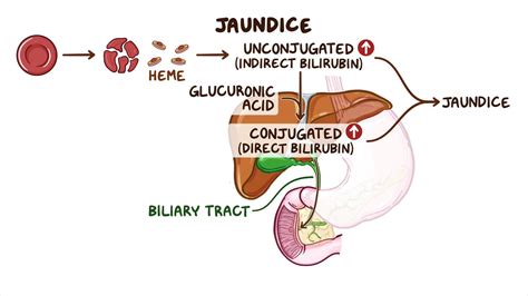 Video: Approach to jaundice (unconjugated hyperbilirubinemia): Clinical sciences | Osmosis