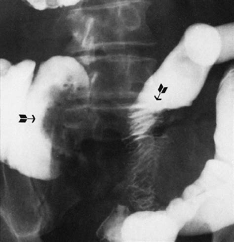 Bildergebnis für ruptured abscess on colon