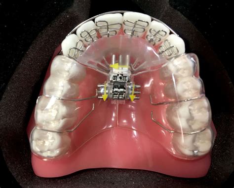 Adult Palatal Expanders-What Appliances Work for Adults