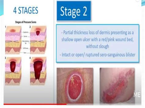 Definitions Pressure ulcers: Nursing home providers were asked the ...