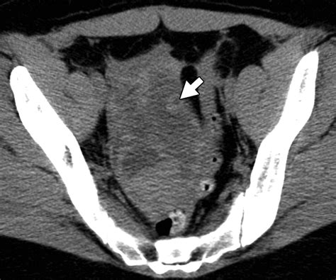 Suspensory Ligament Of Ovary Cat