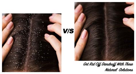Get Rid Off Dandruff With These Natural Solutions To Welcome A Healthi ...