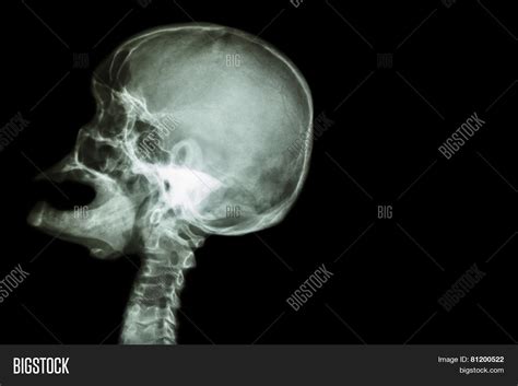 Open Mouth Skull Side View