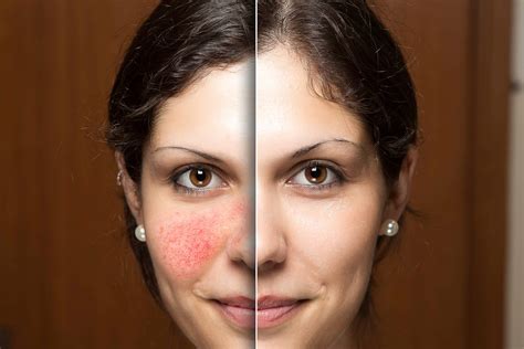 Beauty skin care laser treatment for rosacea — Guide